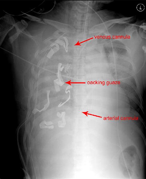 Chest Radiograph Obtained When The Patient Was Transferred To The