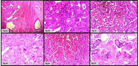 A Tumor Showing Perimuscular Connective Tissue Infiltration Hand ×