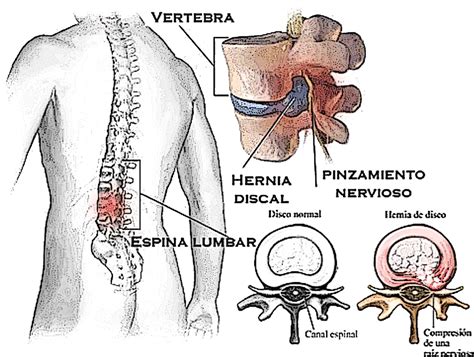 Trastornos De La Columna Vertebral Juan Aibar Neurocirugia