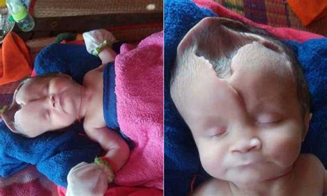 Baby girl born with part of her skull MISSING | Daily Mail Online