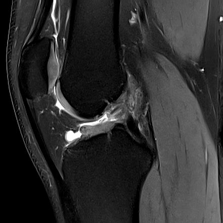 Dorsal Defect Of Patella Radiology Case Radiopaedia Org