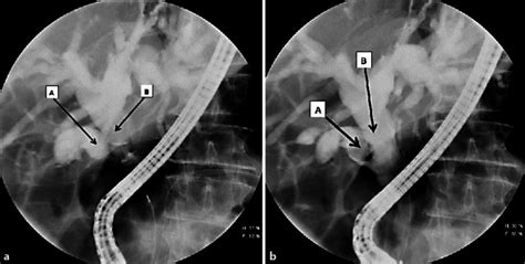 A Dilated Cystic Duct A And Dilated Cbd B Proximal To The