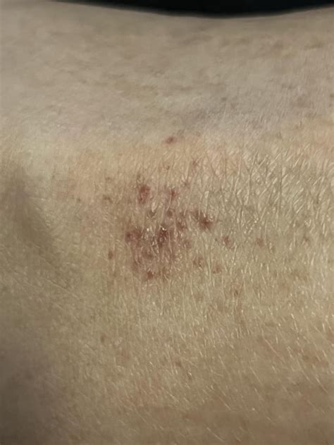 Itchy Red Spots On Ankle Rdermatologyquestions