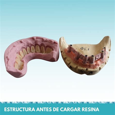 Caso De Prótesis Híbrida sobre 6 implantes Micodent Laboratorio