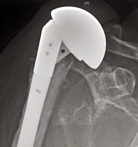 UW Shoulder and Elbow Academy: Reverse total shoulder joint replacement