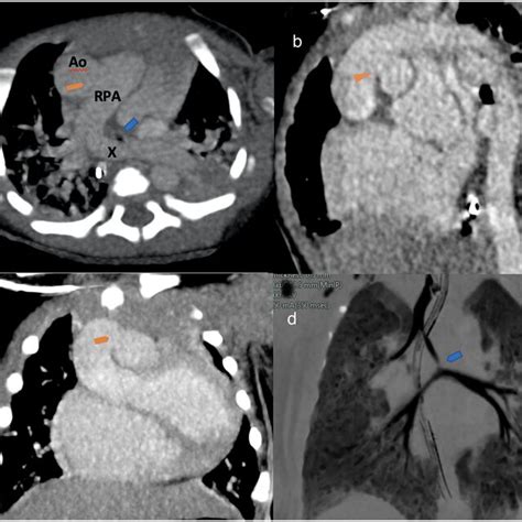 A CT Angiography Of Axial Oblique Multiplanar Reconstruction MPR