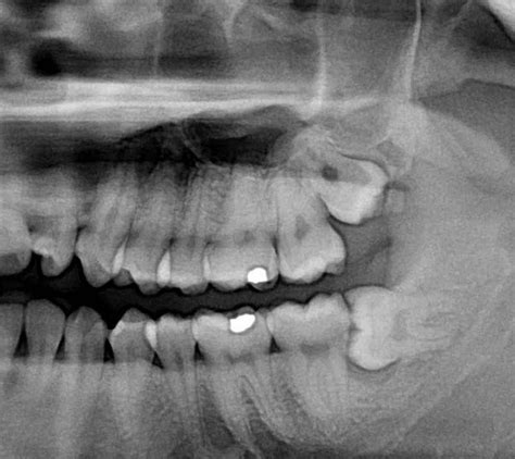 What is an Impacted Tooth?