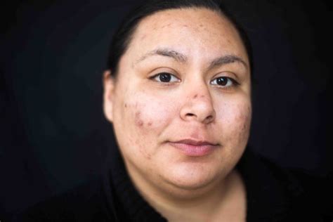 Removing Tattoos To Erase The Scars Of Sex Trafficking The Atlantic