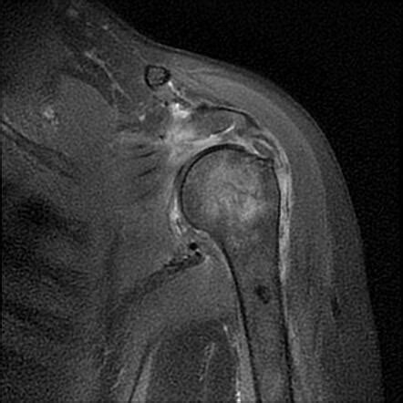 Anterior Shoulder Dislocation With Hill Sachs Defect And Bony Bankart