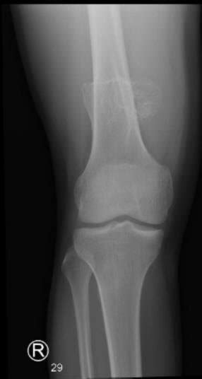 Radiography With Anteroposterior And Lateral View Suggests