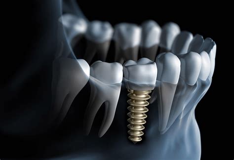 Are Dental Implants Safe What You Should Know