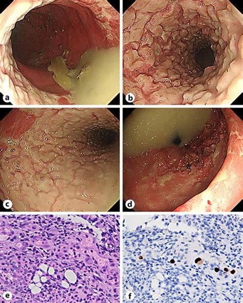 Figure 2 From Cytomegalovirus Colitis With A Cobblestone Appearance Semantic Scholar