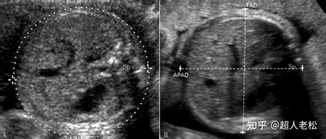 明明白白做超声（二十）：胎儿发育超声评估2—孕龄与中晚期测量 知乎