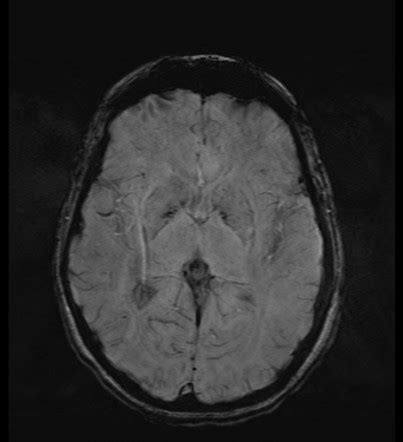 Choroid Plexus Xanthogranuloma Image Radiopaedia Org