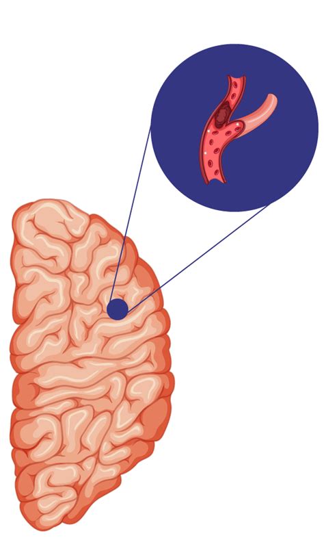 Acv Conoce Que Es El Ataque Cerebrovascular