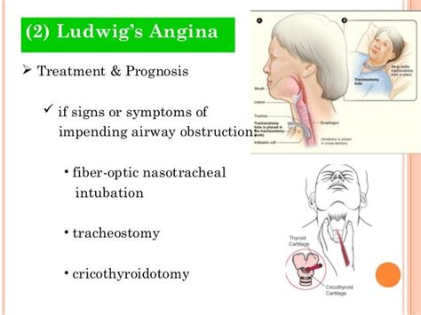 Odontogenic Infections 4