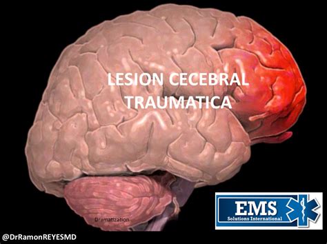 Lesión Cerebral Traumática por Clinica Mayo MED TAC International Corp