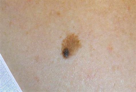 Mole Or Melanoma Test Yourself With These Suspicious Lesions