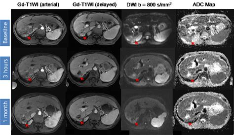 Diagnostics | Special Issue : Diagnosis of Hepatocellular Carcinoma