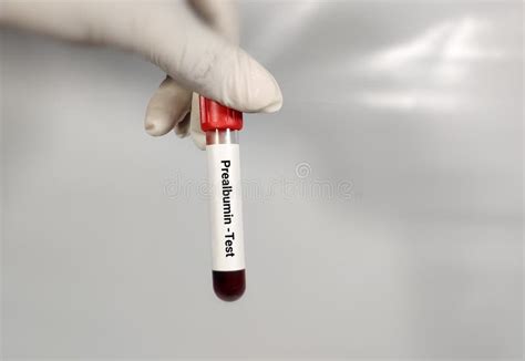 Prealbumin Blood Test Stock Photos - Free & Royalty-Free Stock Photos from Dreamstime