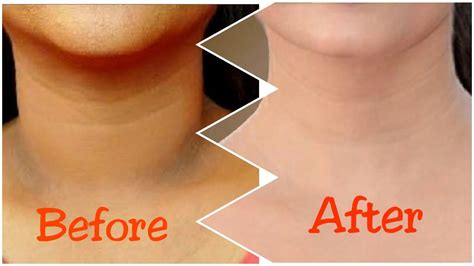 How To Get Rid of Dark Neck in 15 Minutes | Fast and Qu... | Doovi