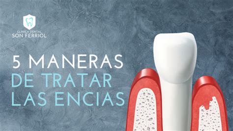 5 Maneras De Detener El Sangrado De EncÍas Clínica Dental Son Ferriol