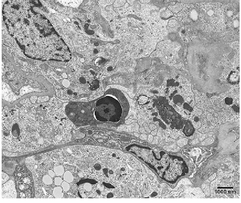 Transmission Electron Microscopic Image Of An Apoptotic Cell In A Human