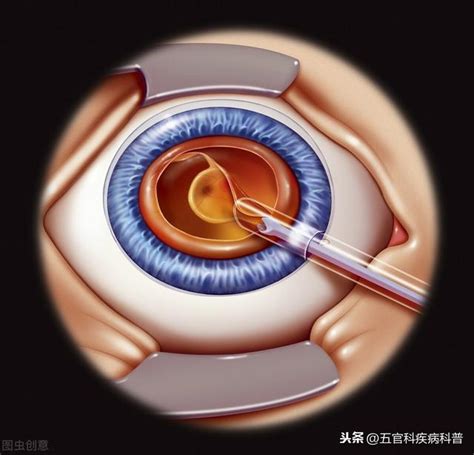 治療白內障，手術全過程僅需要四步 每日頭條