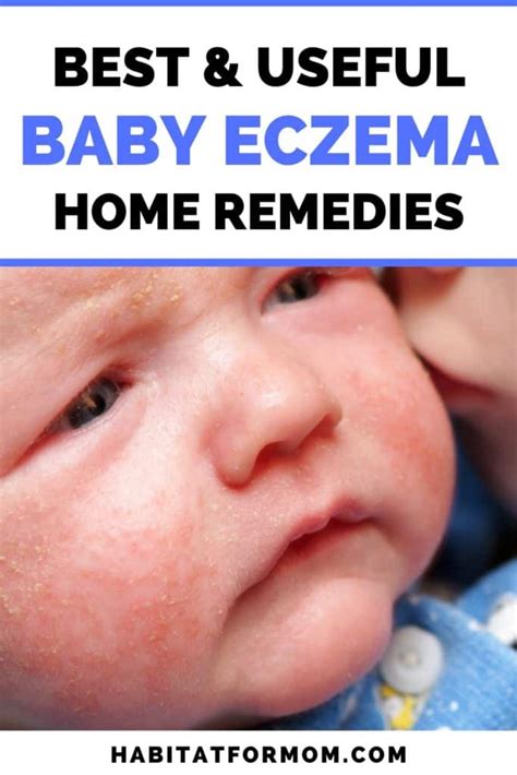 Best Remedies for Baby Eczema (ultimate list) | Habitat For Mom