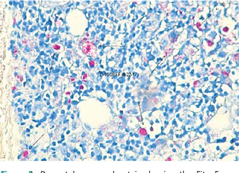 Mycobacterium Leprae Acid Fast