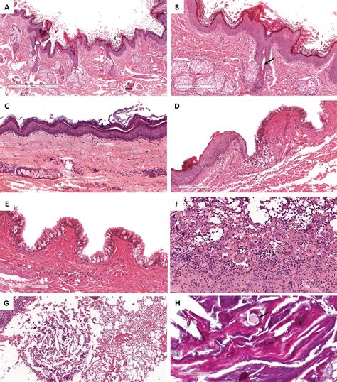 Scielo Brasil Clinicopathologic Analysis Of Oral Dermoid And