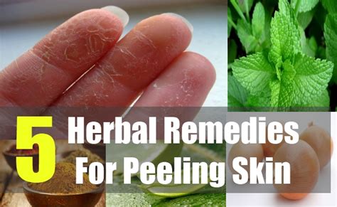 5 Best Herbal Remedies For Peeling Skin How To Get Rid Of Natural Home Remedies And Supplements