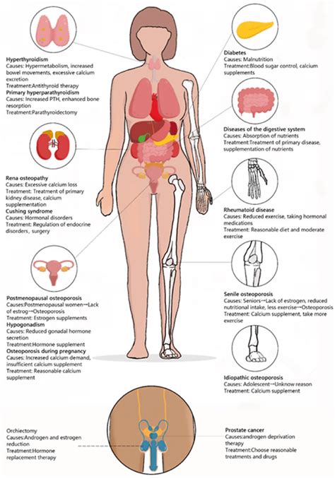 Main Causes And Diseases Of Osteoporosis Main Causes Of Osteoporosis