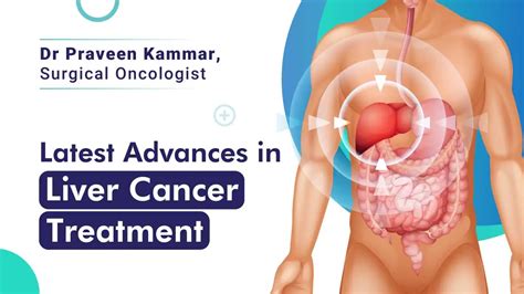 The Latest Advances In Liver Cancer Treatment Dr Praveen Kammar