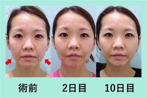 糸リフト単独よりも効果的「小顔組み合わせ治療」 Womクリニック銀座