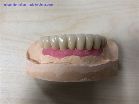 Full Arch Screw Retained Implant Pfm Bridge On Zimmer Implant System