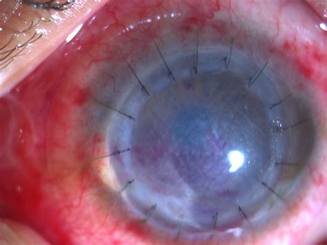 Deep Anterior Lamellar Keratoplasty For Ocular