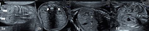 Frontiers Prenatal Diagnosis And Findings In Ureteropelvic Junction