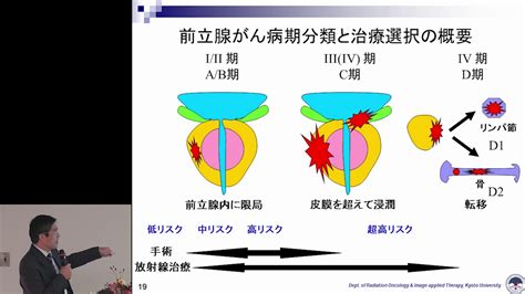 前立腺がんに対する放射線外部照射療法の最前線 溝脇 尚志 氏 Youtube