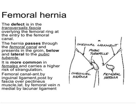 Femoral Hernia Medizzy