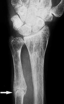 Osteomalacia And Ricket S Flashcards Quizlet