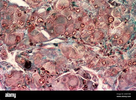 Benign Testicle Tumour Light Micrograph Of Tissue From A Testicle In A