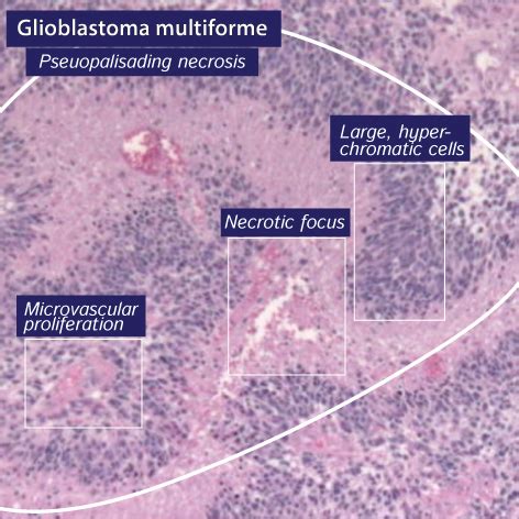 Clinical Pathology Glossary Glioblastoma Multiforme Ditki Medical