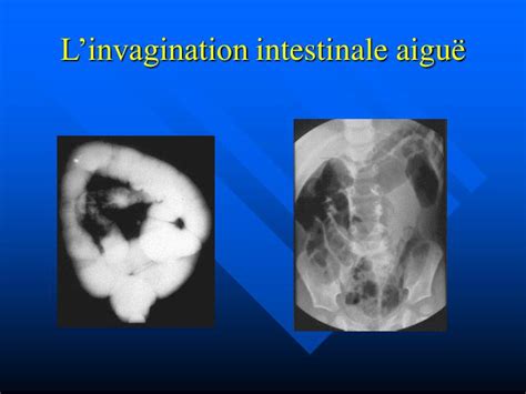 PPT LES URGENCES CHIRURGICALES DU NOURRISSON Invagination Intestinale