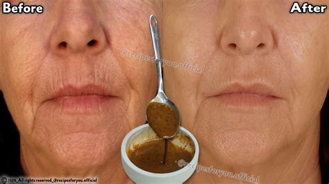 Facelift With Natural Collagen At Years Wrinkles Disappear In