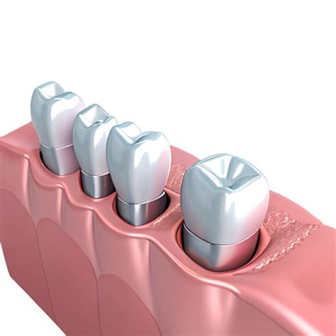 Dental Implant Crown