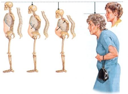 Osteoporosis Signs, Causes & Treatments - Life Health Max