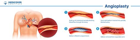 Angioplastia Tipos Indica Es Procedimento Recupera O E Custo