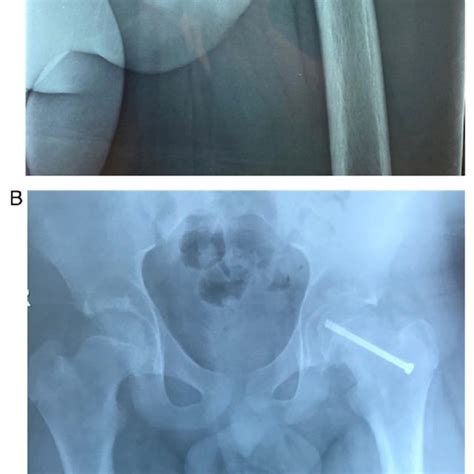 Diagnostic signs of SCFE shown on the AP (A) and FL (B) pelvis view of ...