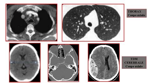 Tomodensitometrie Tdm Ou Scanner Ou Ct Scan Anne